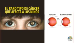 Retinoblastoma, un raro tipo de cáncer ocular que afecta a los niños